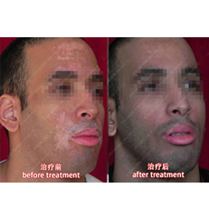 特殊部位（口唇、眼角等黏膜处等）白癜风治疗技术