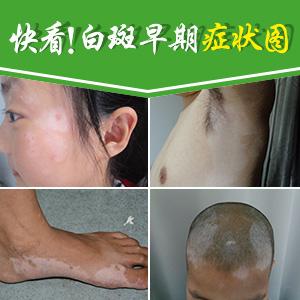 有了白癜风早期症状，治疗上应该注意什么？